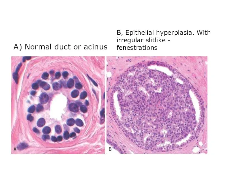 A) Normal duct or acinus B, Epithelial hyperplasia. With irregular slitlike - fenestrations