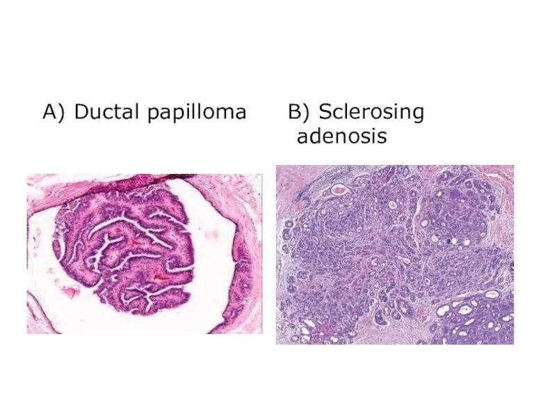 A) Ductal papilloma B) Sclerosing adenosis