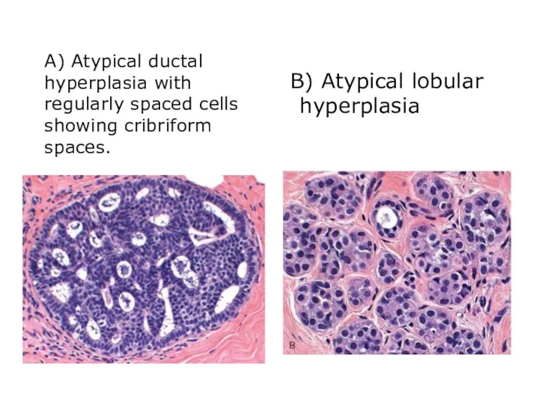 A) Atypical ductal hyperplasia with regularly spaced cells showing cribriform spaces. B) Atypical lobular hyperplasia