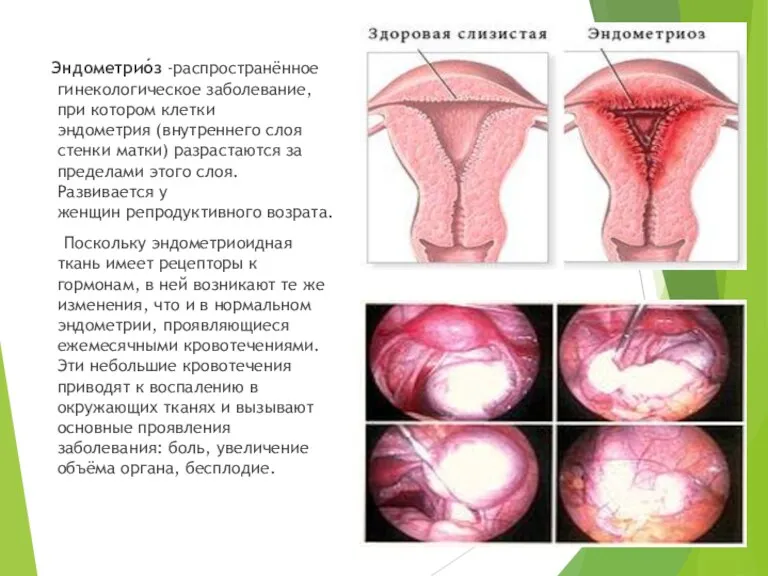 Эндометрио́з -распространённое гинекологическое заболевание, при котором клетки эндометрия (внутреннего слоя стенки матки) разрастаются