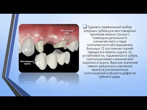 Сделать правильный выбор опорных зубов для мостовидных протезов можно только