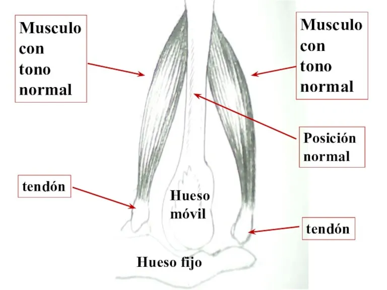 Musculo con tono normal Musculo con tono normal Hueso fijo Hueso móvil tendón tendón Posición normal