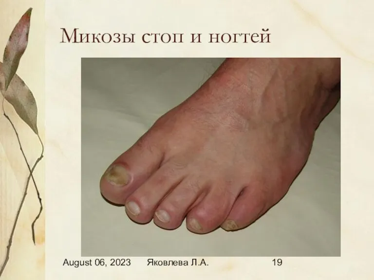 August 06, 2023 Яковлева Л.А. Микозы стоп и ногтей