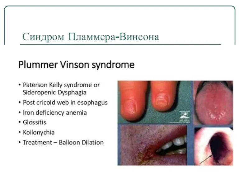 Синдром Пламмера-Винсона