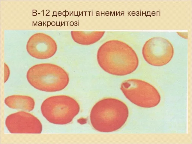 В-12 дефицитті анемия кезіндегі макроцитозі