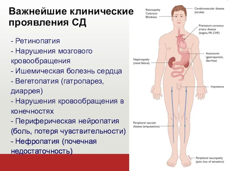 Важнейшие клинические проявления СД - Ретинопатия - Нарушения мозгового кровообращения