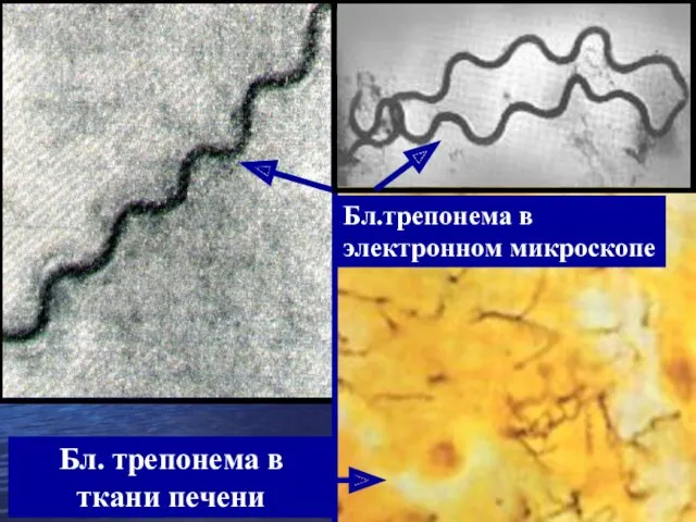 Бл.трепонема в электронном микроскопе Бл. трепонема в ткани печени