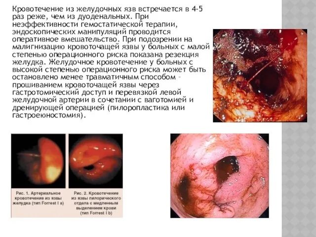 Кровотечение из желудочных язв встречается в 4-5 раз реже, чем из дуоденальных. При