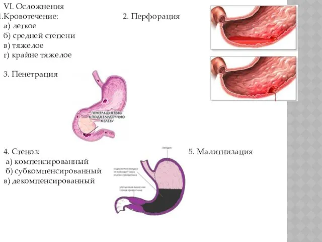 VI. Осложнения Кровотечение: 2. Перфорация а) легкое б) средней степени