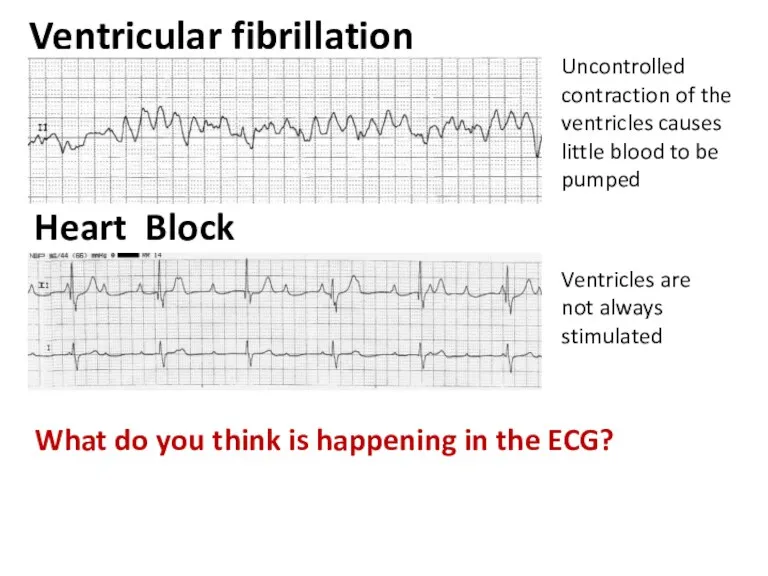 Ventricular fibrillation What do you think is happening in the