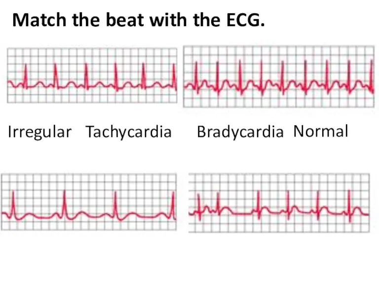 Match the beat with the ECG. Tachycardia Irregular Normal Bradycardia