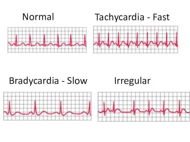 Tachycardia - Fast Irregular Normal Bradycardia - Slow