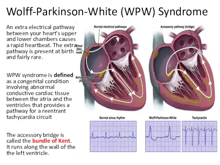 Wolff-Parkinson-White (WPW) Syndrome An extra electrical pathway between your heart's