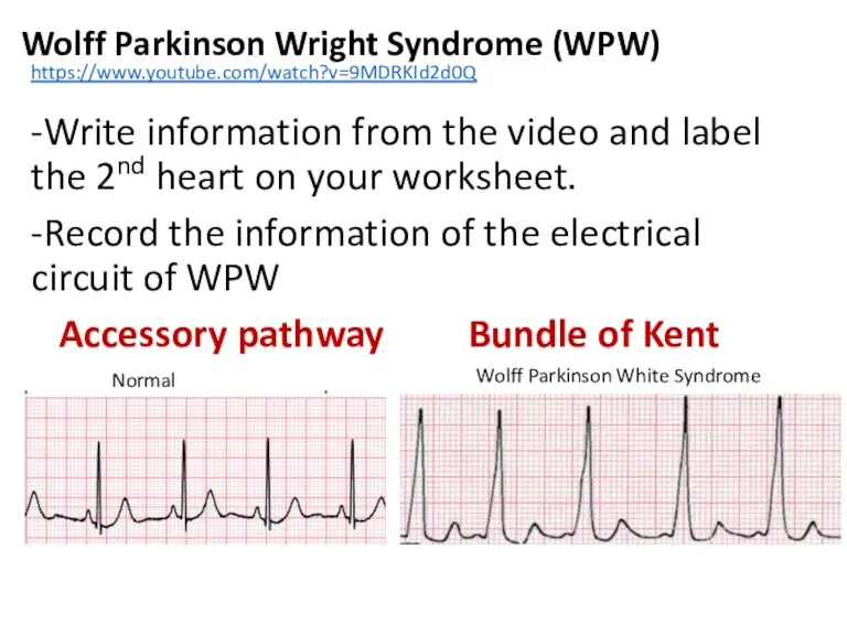 Wolff Parkinson Wright Syndrome (WPW) -Write information from the video