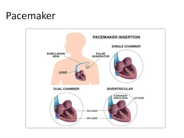 Pacemaker