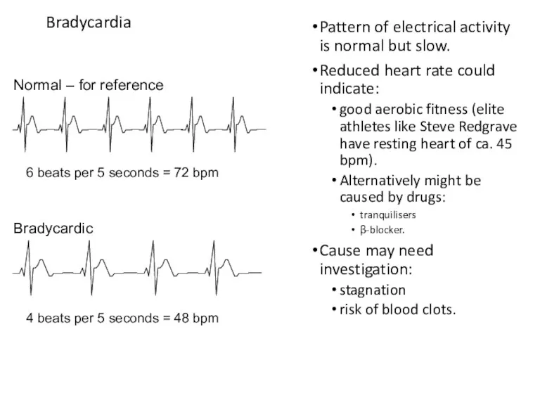 Bradycardia Pattern of electrical activity is normal but slow. Reduced