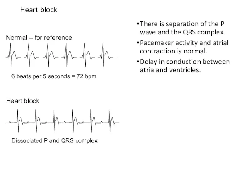 Heart block There is separation of the P wave and