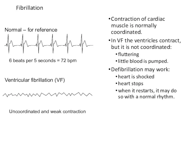 Fibrillation Contraction of cardiac muscle is normally coordinated. In VF