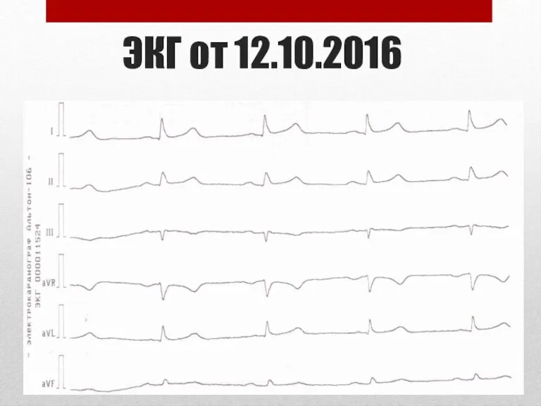 ЭКГ от 12.10.2016