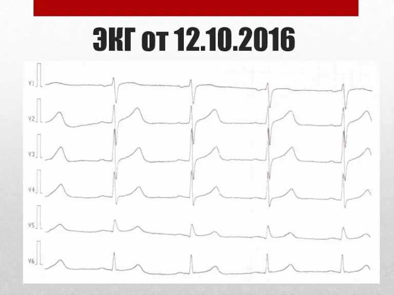 ЭКГ от 12.10.2016