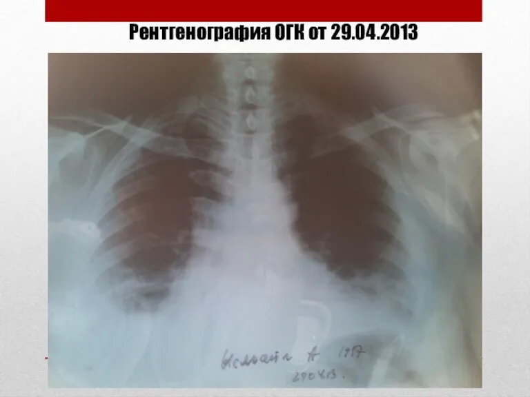 Рентгенография ОГК от 29.04.2013