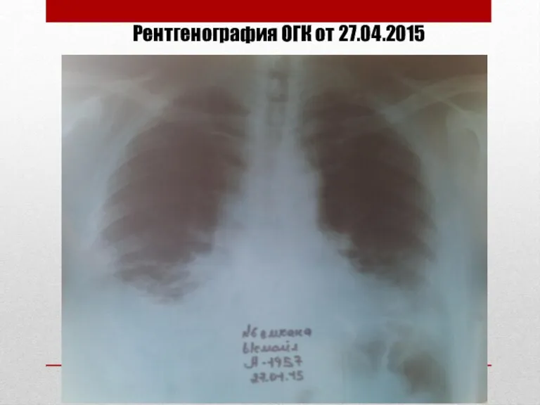 Рентгенография ОГК от 27.04.2015