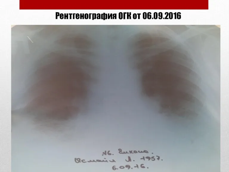 Рентгенография ОГК от 06.09.2016