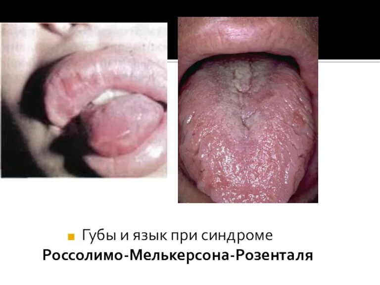 Губы и язык при синдроме Россолимо-Мелькерсона-Розенталя