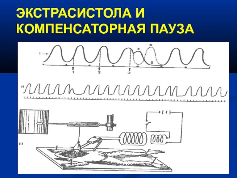 ЭКСТРАСИСТОЛА И КОМПЕНСАТОРНАЯ ПАУЗА