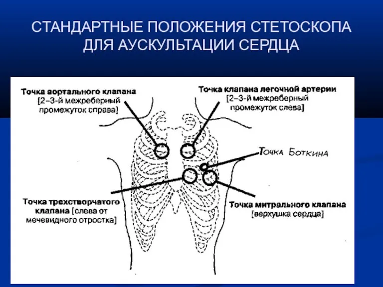 СТАНДАРТНЫЕ ПОЛОЖЕНИЯ СТЕТОСКОПА ДЛЯ АУСКУЛЬТАЦИИ СЕРДЦА