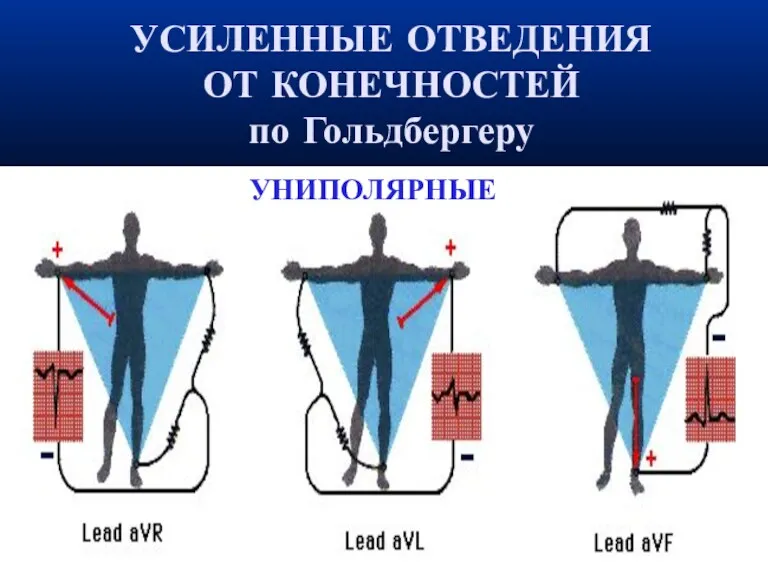 УСИЛЕННЫЕ ОТВЕДЕНИЯ ОТ КОНЕЧНОСТЕЙ по Гольдбергеру‏ УНИПОЛЯРНЫЕ