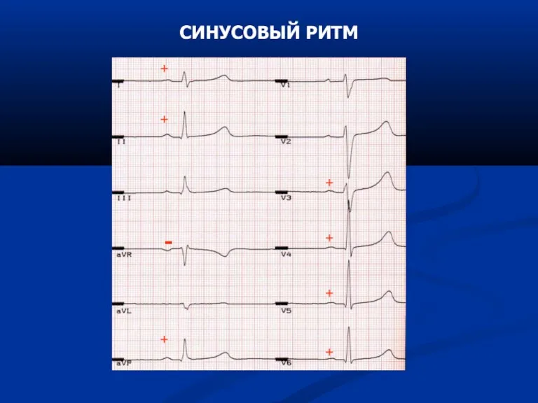 СИНУСОВЫЙ РИТМ + + + + + + + -