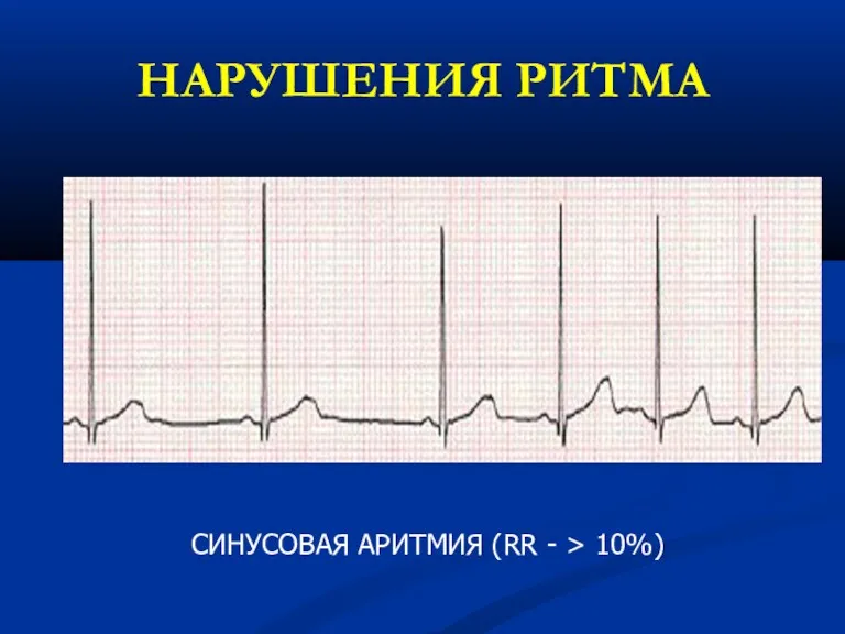 НАРУШЕНИЯ РИТМА СИНУСОВАЯ АРИТМИЯ (RR - > 10%)