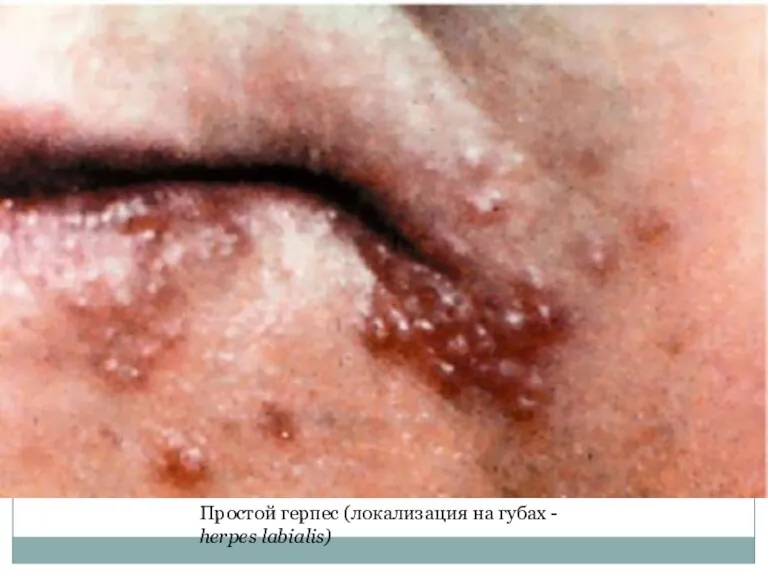 Простой герпес (локализация на губах - herpes labialis)