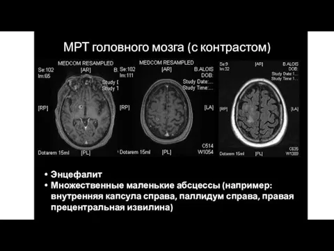 Энцефалит Множественные маленькие абсцессы (например: внутренняя капсула справа, паллидум справа, правая прецентральная извилина)