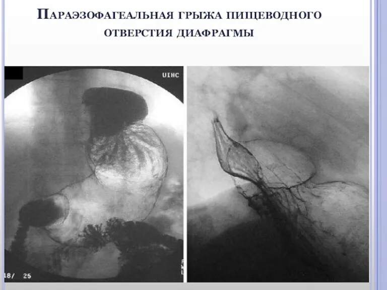 Параэзофагеальная грыжа пищеводного отверстия диафрагмы
