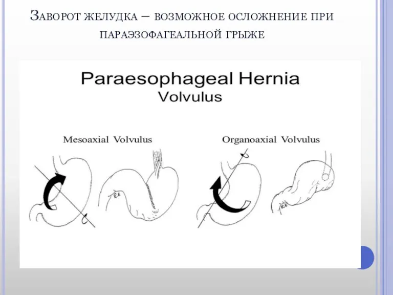 Заворот желудка – возможное осложнение при параэзофагеальной грыже