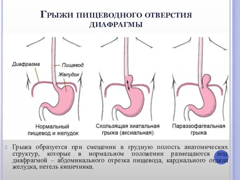 Грыжи пищеводного отверстия диафрагмы Грыжа образуется при смещении в грудную