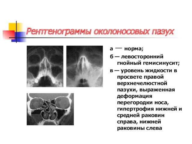 Рентгенограммы околоносовых пазух а — норма; б — левосторонний гнойный