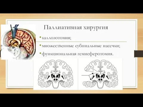 Паллиативная хирургия каллозотомия; множественные субпиальные насечки; функциональная гемисферотомия.