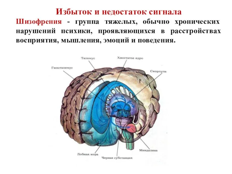 Избыток и недостаток сигнала Шизофрения - группа тяжелых, обычно хронических