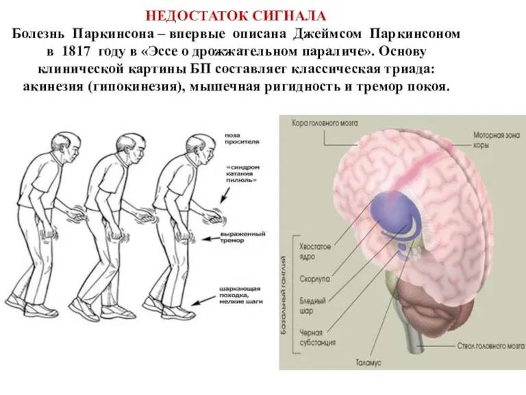 НЕДОСТАТОК СИГНАЛА Болезнь Паркинсона – впервые описана Джеймсом Паркинсоном в