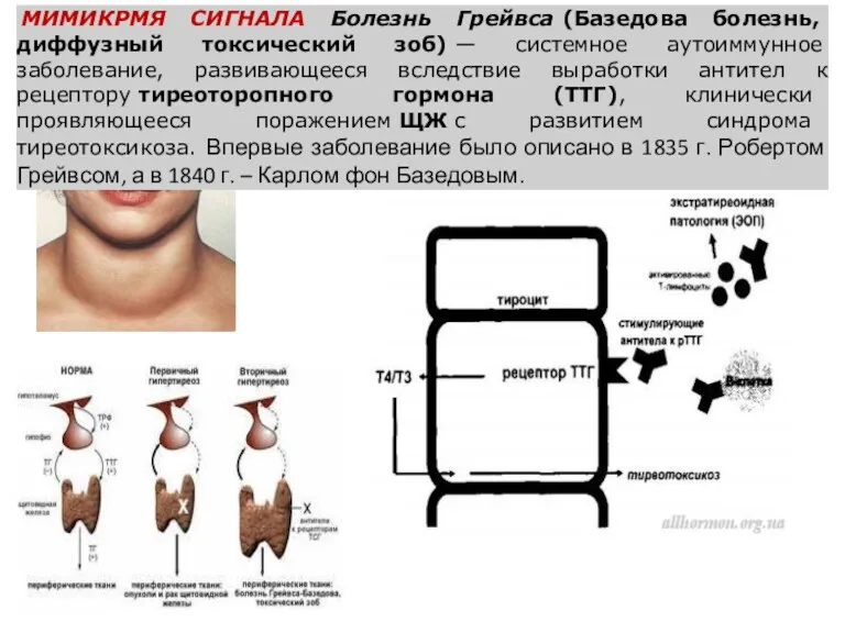 МИМИКРМЯ СИГНАЛА Болезнь Грейвса (Базедова болезнь, диффузный токсический зоб) —