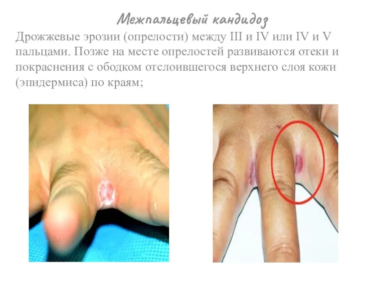 Межпальцевый кандидоз Дрожжевые эрозии (опрелости) между III и IV или