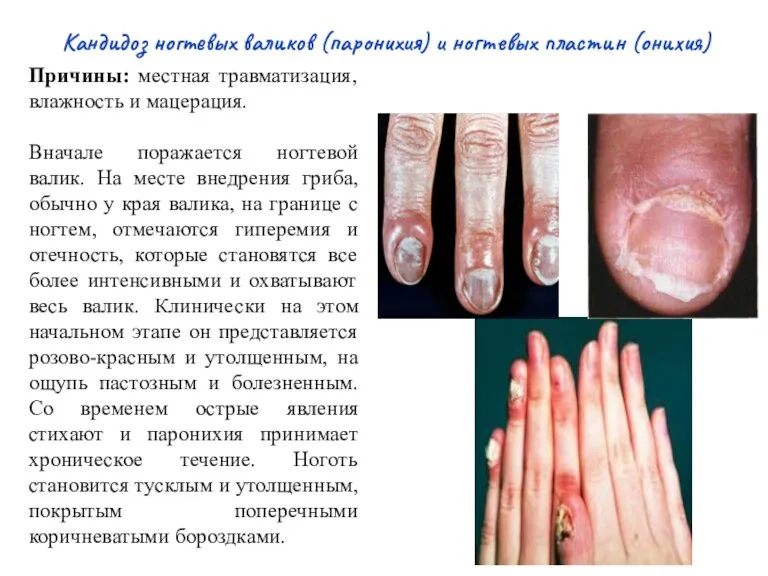 Кандидоз ногтевых валиков (паронихия) и ногтевых пластин (онихия) Причины: местная травматизация, влажность и