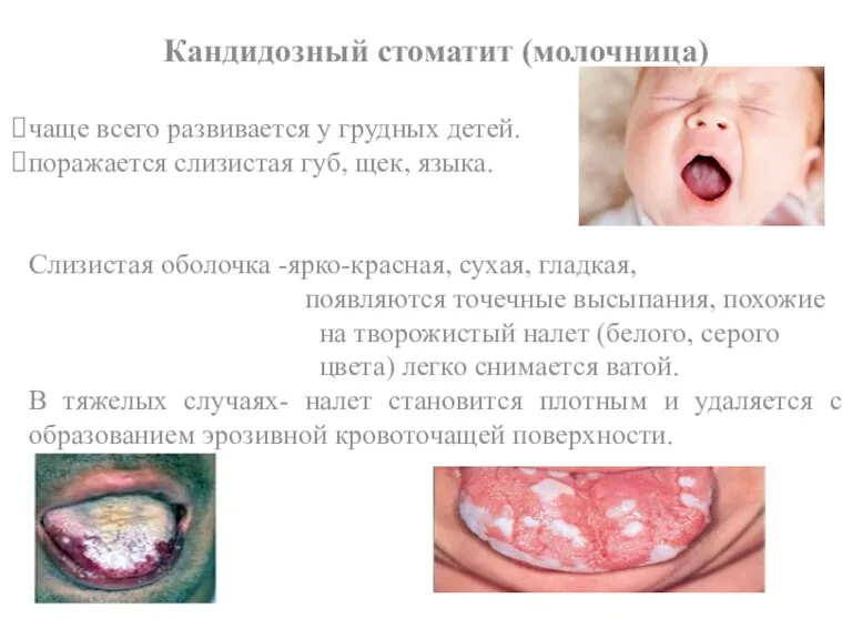 Кандидозный стоматит (молочница) чаще всего развивается у грудных детей. поражается слизистая губ, щек,