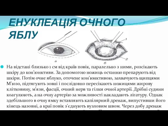 ЕНУКЛЕАЦІЯ ОЧНОГО ЯБЛУКА На від­стані близько 1 см від країв