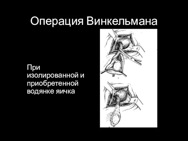 Операция Винкельмана При изолированной и приобретенной водянке яичка