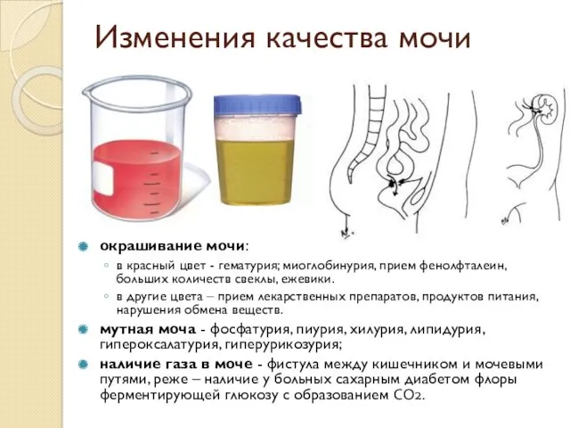 Изменения качества мочи окрашивание мочи: в красный цвет - гематурия;