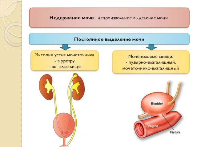 Недержание мочи– непроизвольное выделение мочи. Постоянное выделение мочи Мочеполовые свищи: